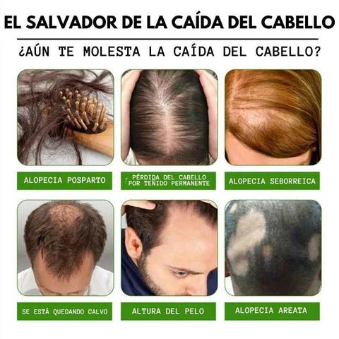 Sérum Capilar de Jengibre Anticaída (Esencia Germinal)